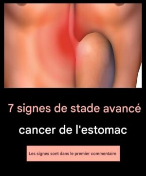 7 signes d’un cancer de l’estomac à un stade avancé