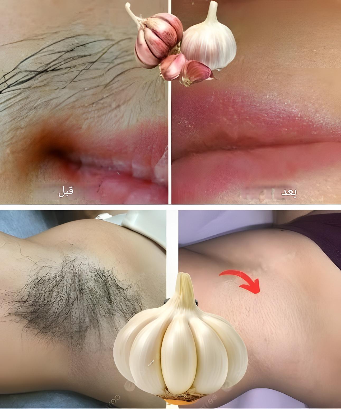 كيف يُحدث الثوم عجائب في إزالة الشعر: دليل شامل