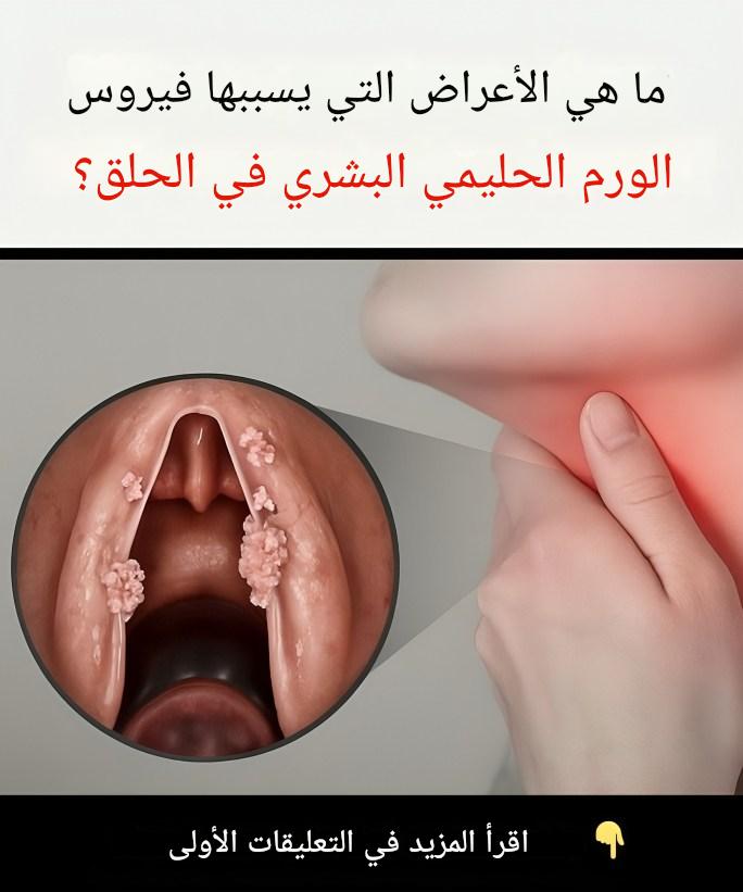 ما هي أعراض فيروس الورم الحليمي البشري في الحلق؟