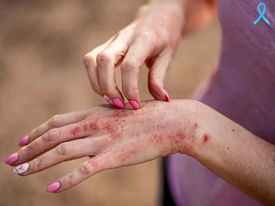 Problemas de Pele Relacionados à Fibromialgia e seu Tratamento