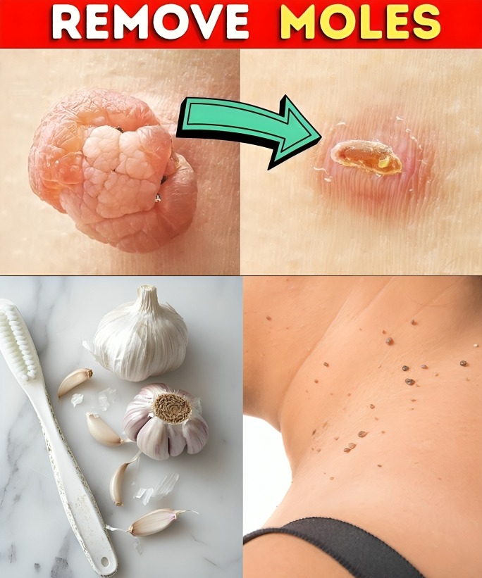 Plantar Warts and Skin Tags Disappear Naturally—Try This Overnight Remedy
