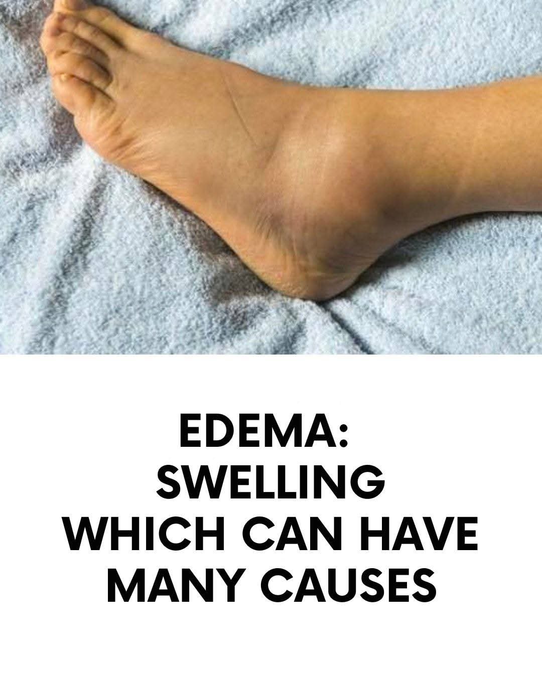 Edema: a swelling that can have many causes
