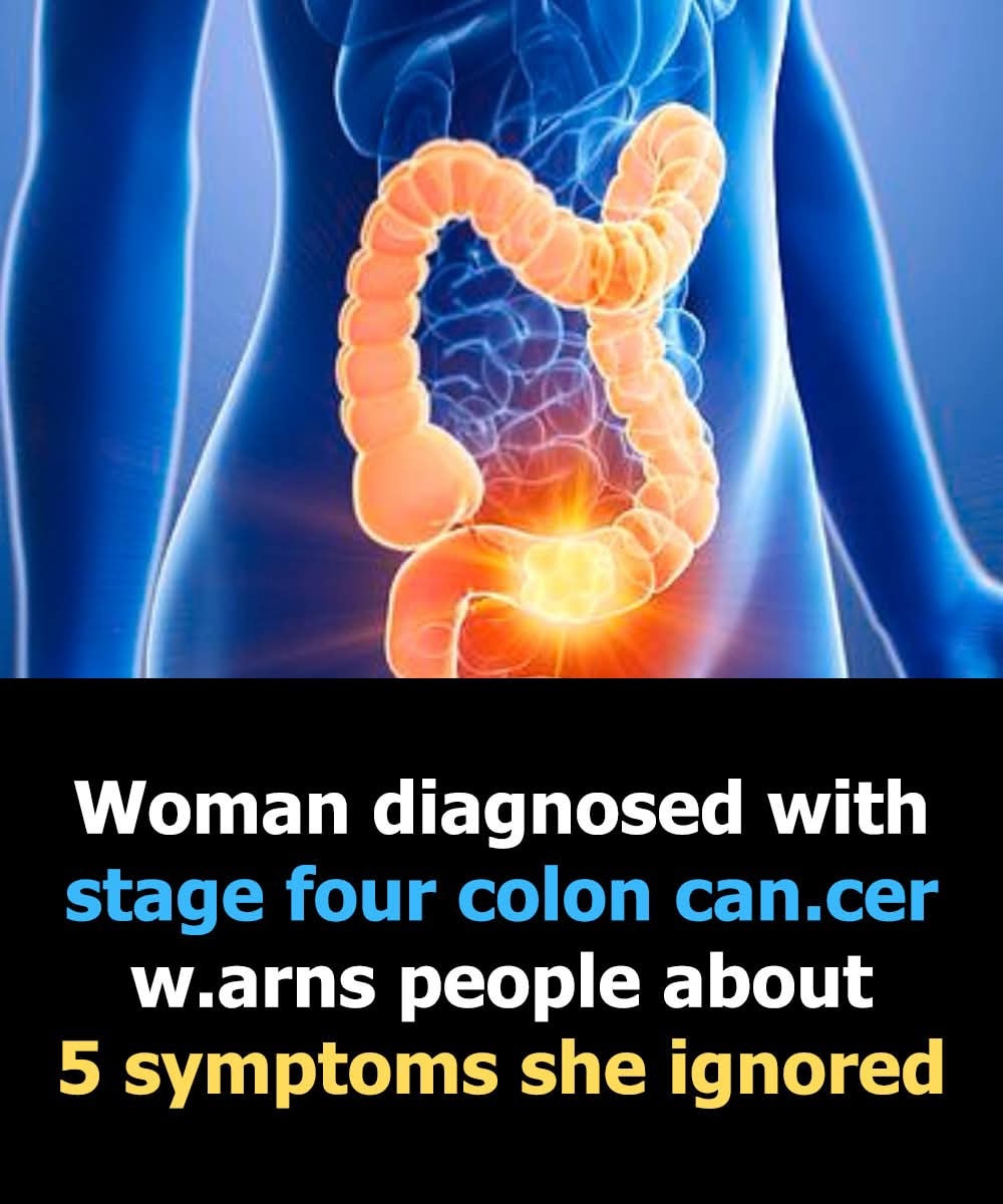 Woman reveals 5 colon cancer symptoms that shouldn’t be ignored
